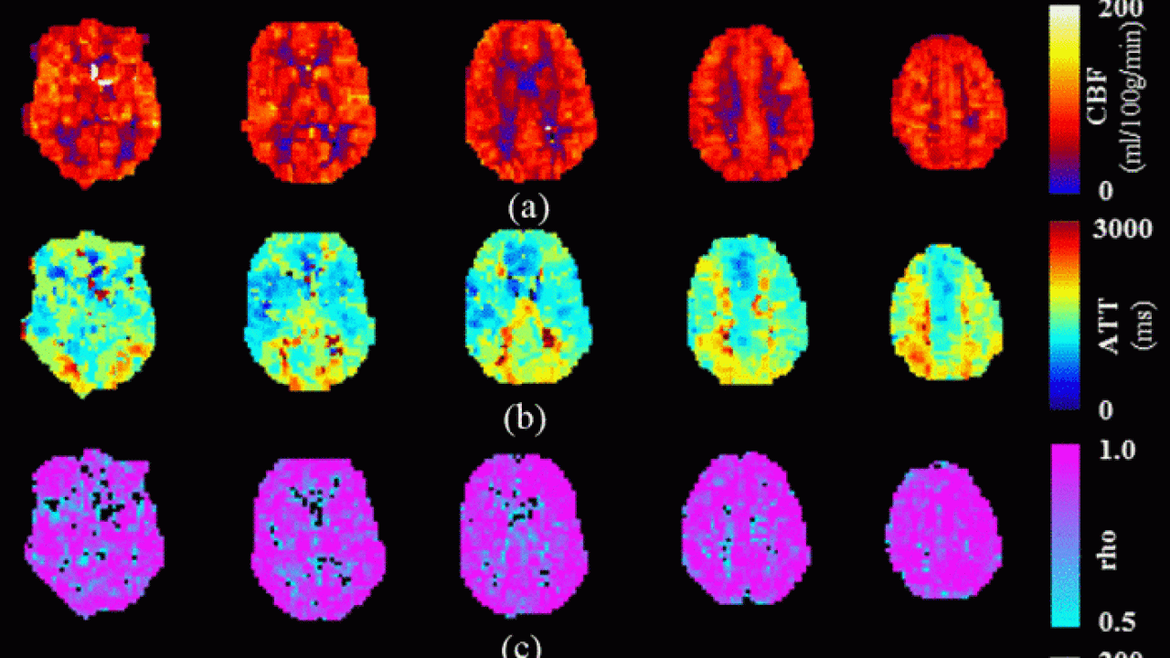 Colored medical brain-scan graphic showing three rows of axial maps with vertical color scale